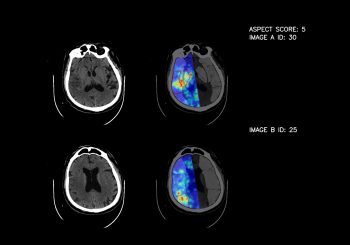 В больнице Страдыня с помощью искусственного интеллекта достигли точности 93% в диагностике инсульта